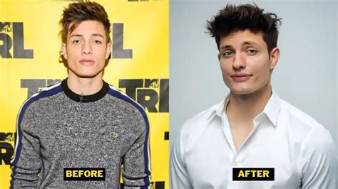 matt rife before and after plastic surgery|Matt Rife Talks Unrecognizable Look, Plastic Surgery Rumors